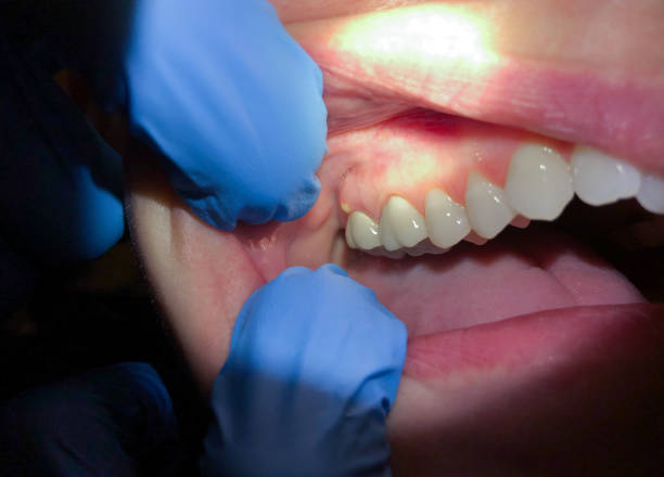 Best Emergency Root Canal Treatment in Rochester, WA